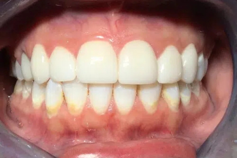 Cosmetic Dentistry - After
