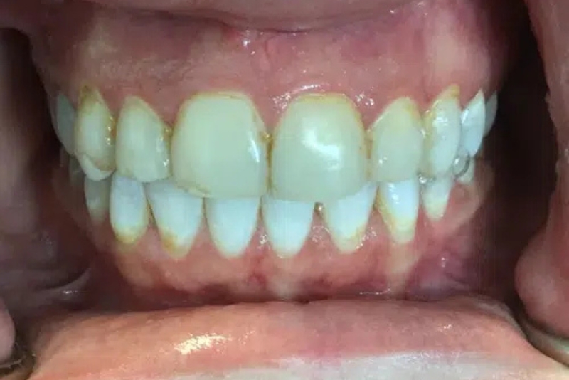 Cosmetic Dentistry - Before