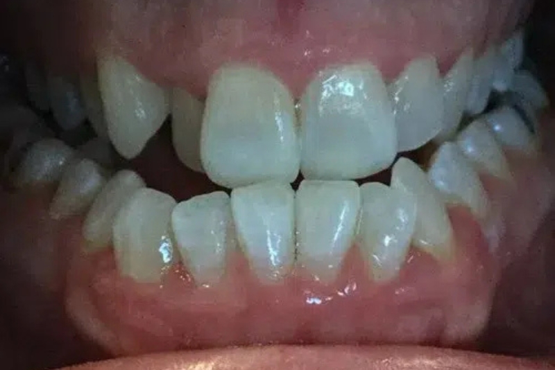 Teeth Whitening - After