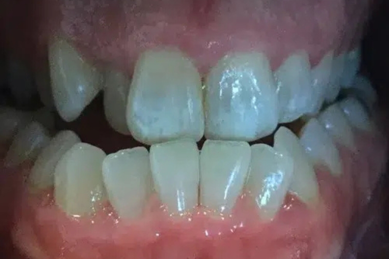 Teeth Whitening - Before