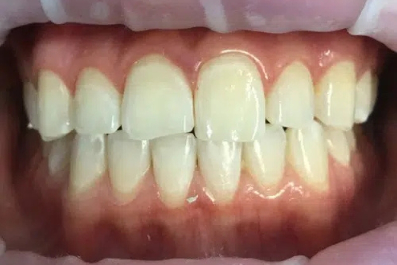 Teeth Whitening - After
