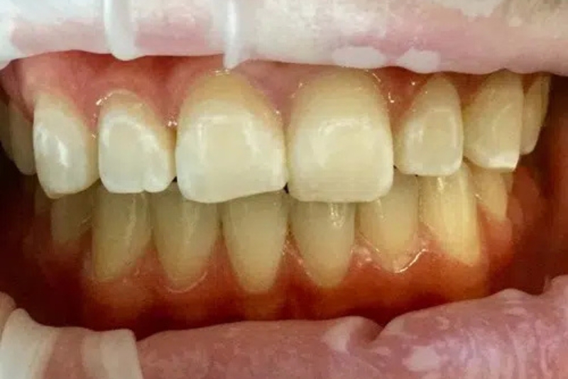 Teeth Whitening - Before