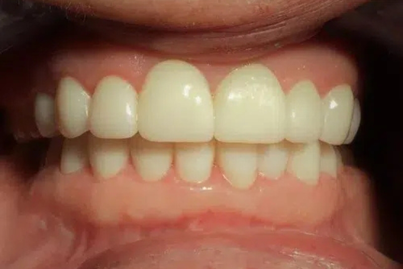 Cosmetic Dentistry - After