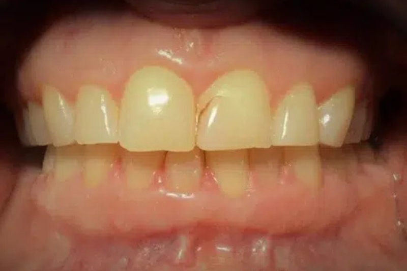 Cosmetic Dentistry - Before