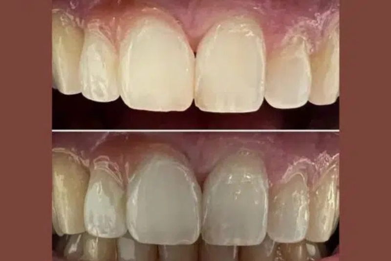 Cosmetic Dentistry - After