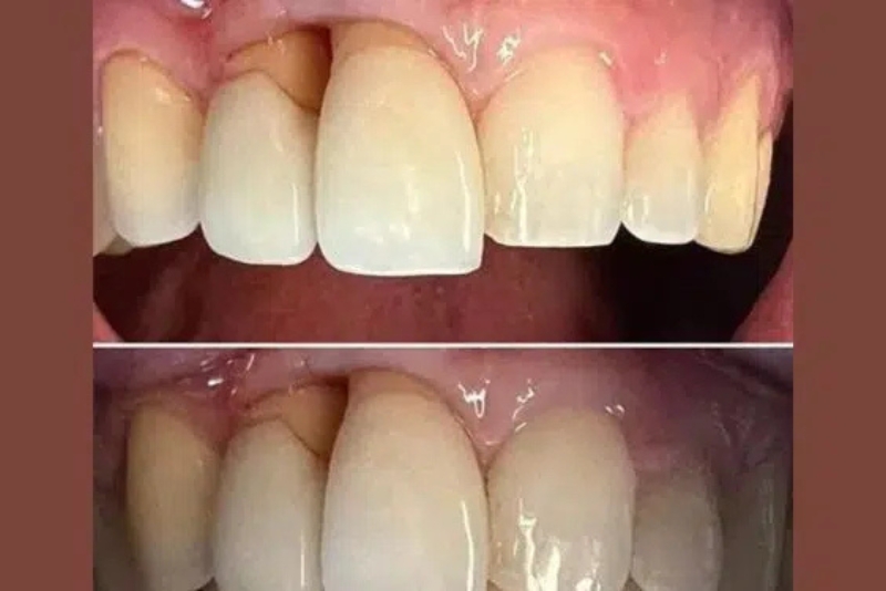 Cosmetic Dentistry - Before