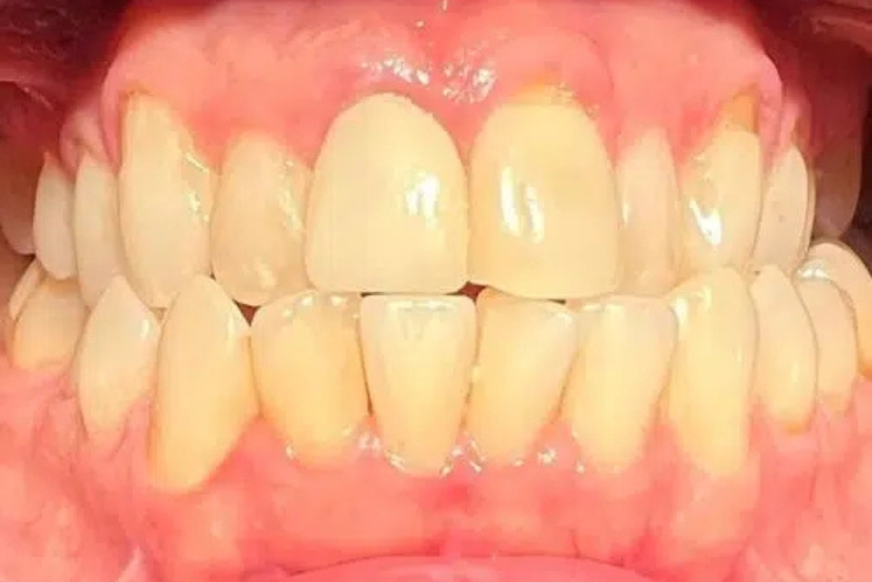 Cosmetic Dentistry - Before