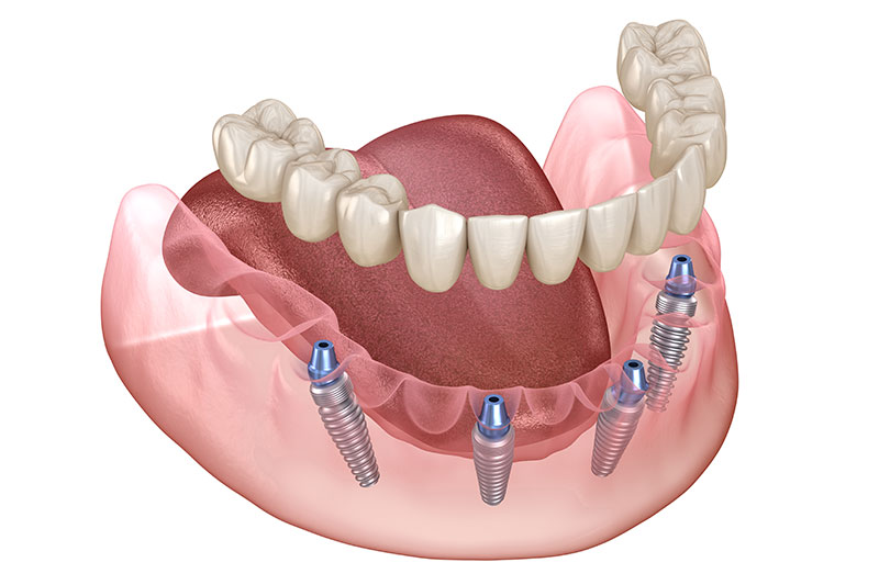 All on X Dental Implants in Hurst