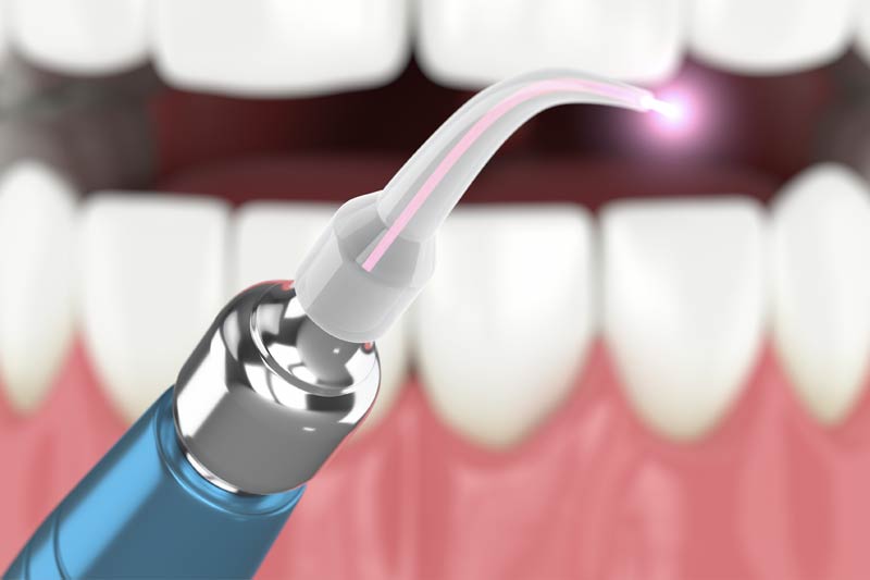 Laser Dentistry in Hurst