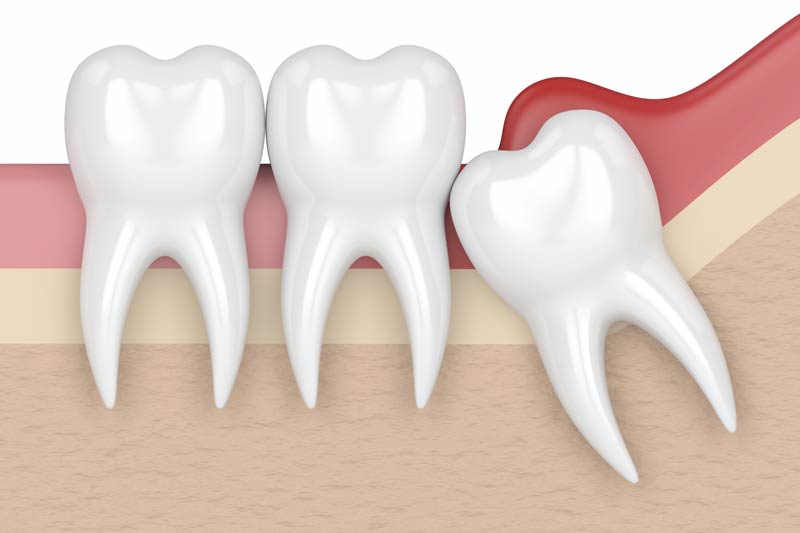 Wisdom Teeth Removal in Hurst
