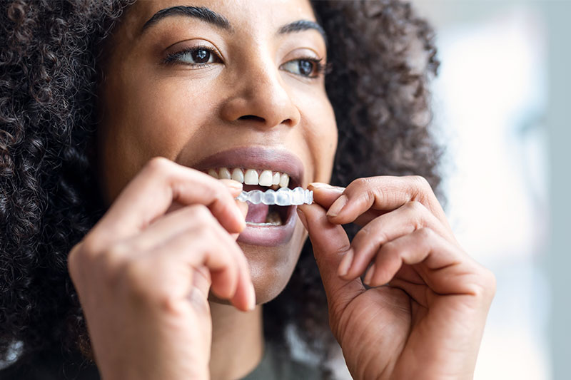 Clear Aligners in League City