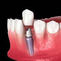 Single Tooth Dental Implant in Willimantic