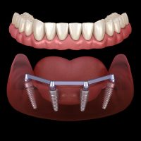 Implant Dentures in South Windsor