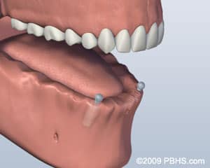 Implant Retained Dentures in 