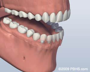 Implant Retained Dentures in 