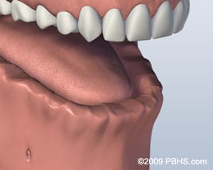 Implant Retained Dentures in 