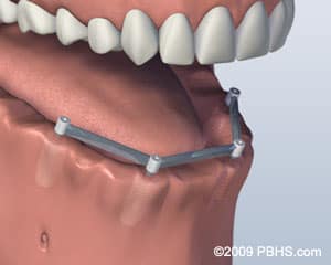 Implant Retained Dentures in 