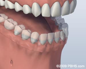 Implant Retained Dentures in 