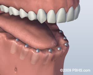 Implant Retained Dentures in 