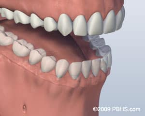 Implant Retained Dentures in 