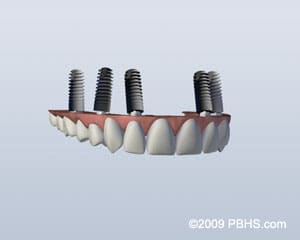 Implant Retained Dentures in Hockessin