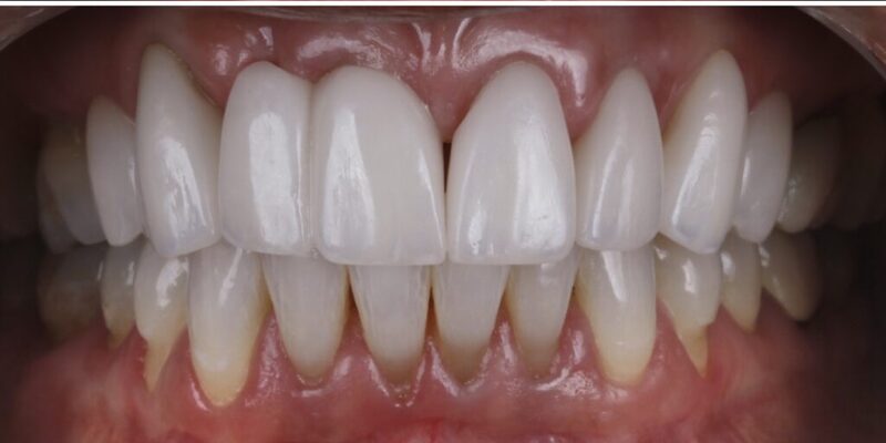 Porcelain Veneers in Hockessin