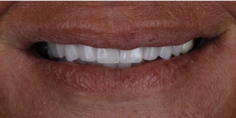Porcelain Veneers in Hockessin