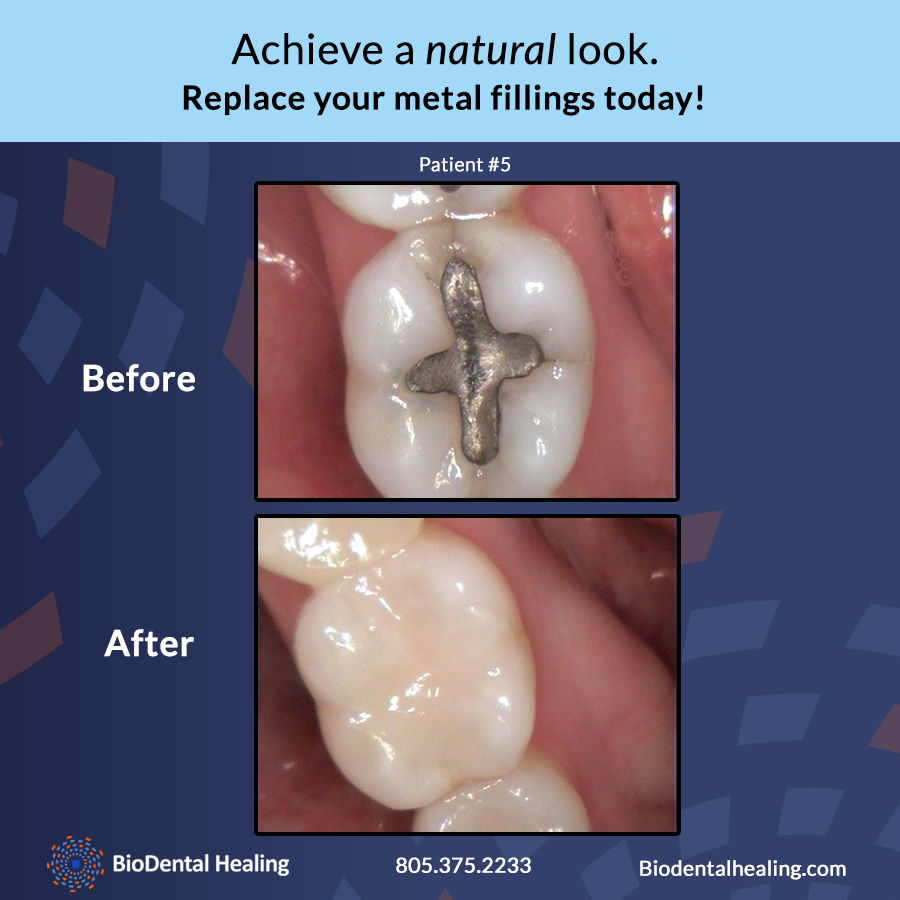 Safe Amalgam Filling Removal in Newbury Park