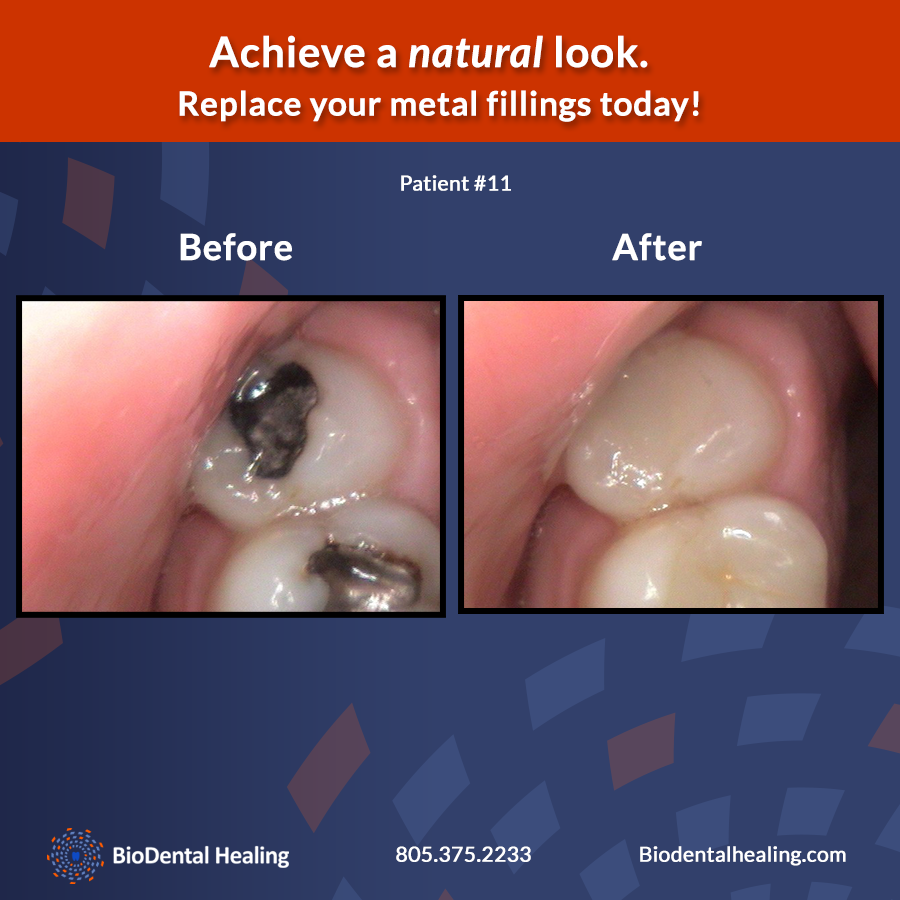 Safe Amalgam Filling Removal in Newbury Park