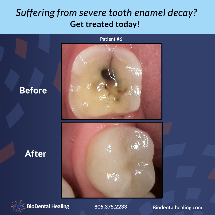 BPA-Free Fillings in Newbury Park