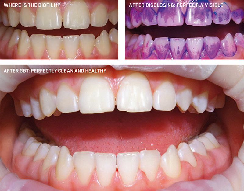 Guided Biofilm Therapy in Columbus