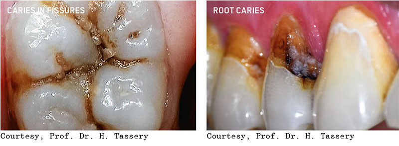 Guided Biofilm Therapy Before After Photos in in Columbus 